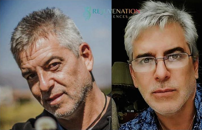 Before and after: male patient anti-aging stem cell treatment