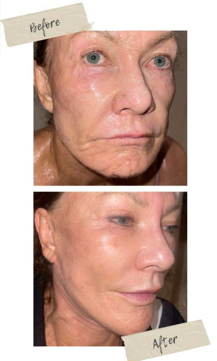 Before and after: female patient skin rejuvenation with stem cells